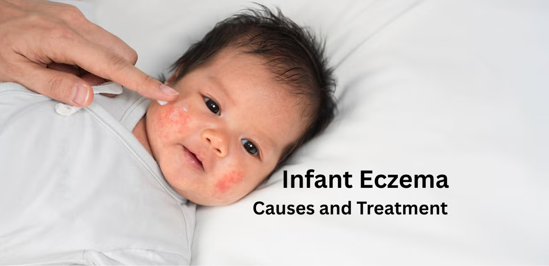 Infant Eczema, Causes and Treatment